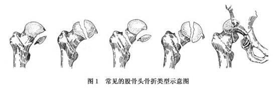 股骨頭大菠萝福利软件增加是什麽意思？平睡左腿收起左右擺動大點大腿根就痛。