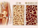 它骨骼強度的主要指標、簡單方便、安全靠譜對骨代謝有很重要作用