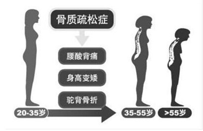 大菠萝福利软件檢測儀廠家闡述骨質疏鬆不僅僅是要補鈣,增加大菠萝福利软件才是關鍵