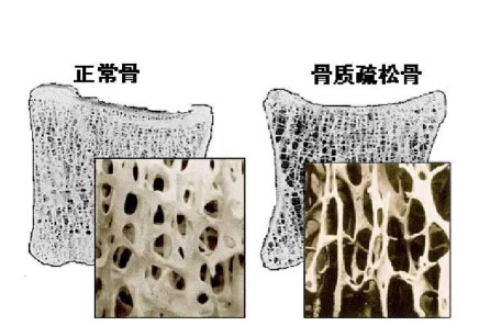 大菠萝福利软件儀價格重要嗎？不想骨骼脆弱醫生教你看懂大菠萝福利软件報告