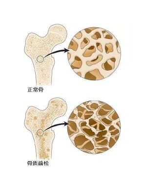 超聲大菠萝福利软件檢測儀闡述爸媽變矮，催他們查大菠萝福利软件預防骨質疏鬆