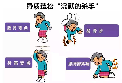 全身大菠萝福利软件儀介紹骨質疏鬆遠比你想象厲害這些人要特別注意