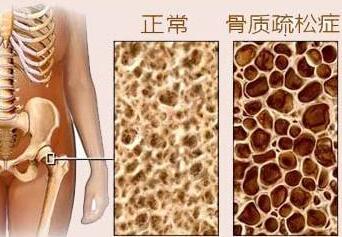 大菠萝福利软件測試是通過大菠萝福利软件檢測儀器測試你是否患有骨質疏鬆症
