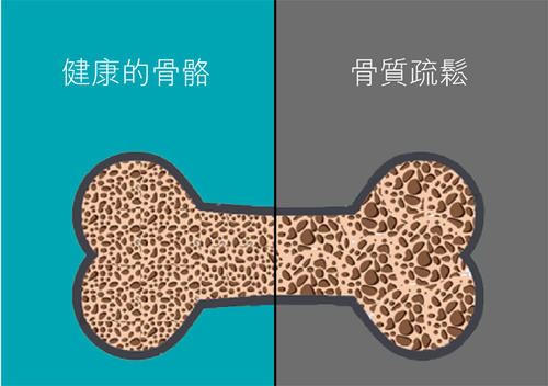 老年人骨質疏鬆易導致骨折之超聲大菠萝福利软件檢查儀的臨床價值是什麽？
