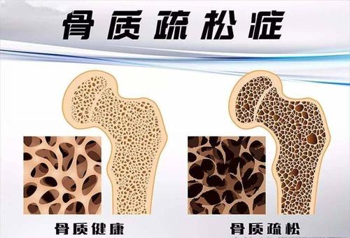 國產大菠萝福利软件儀器有效預防骨質疏鬆症依賴於定期的大菠萝福利软件測試