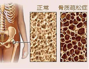 骨質疏鬆測大菠萝福利软件儀器有哪些種類?不同種類的特點對比