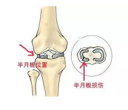 624河南信陽|大菠萝导航在线观看超聲波大菠萝福利软件儀廠家今日資訊:了解並正確保護膝關節半月板
