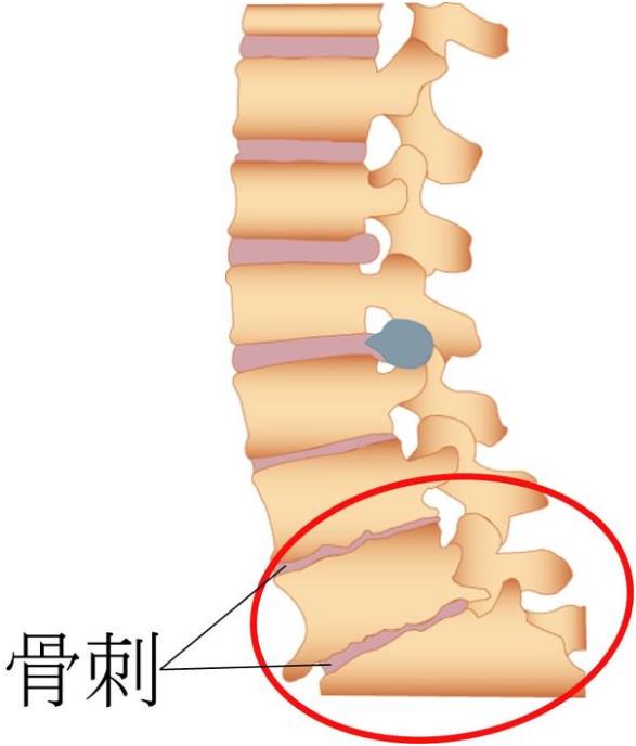 吉林長春|大菠萝导航在线观看超聲大菠萝福利软件儀廠家品牌分享:為什麽現在的年輕人也存在骨刺增生?